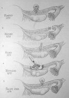 Стерилизующие операции на маточных трубах