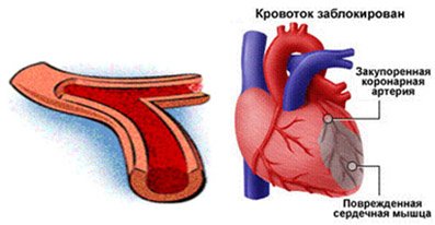 Инфаркт миокарда