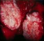 Диагностика рака легких